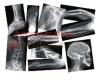 Broken Bones X-Rays